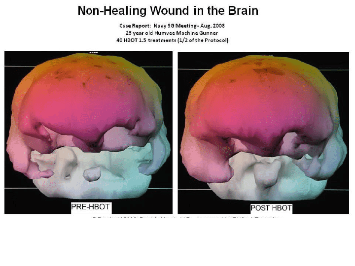 Cerebral lesions