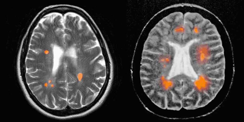 multiple sclerosis